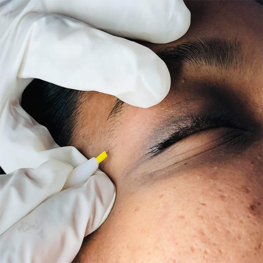 Salma-Electrolysis-Gallery-pic